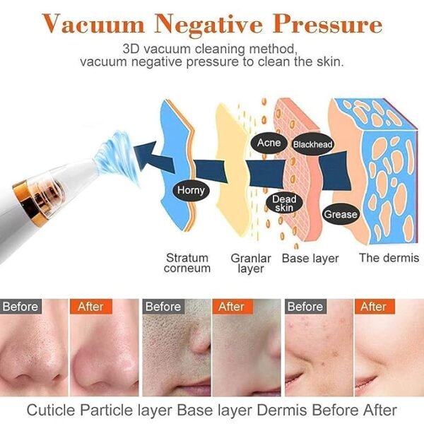 Blackhead Remover Vacuum - Image 5